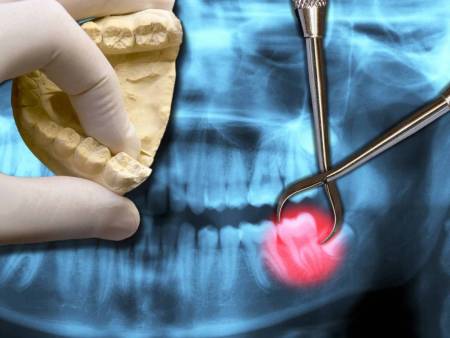 Radiologia odontoiatrica Dentascan TC volumetrica 3D Cone Bean a basso dosaggio